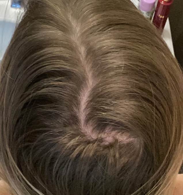 Female pattern baldness in 20s deals